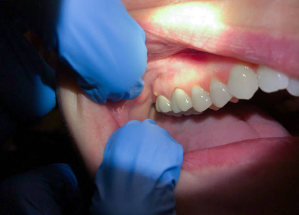 Best Emergency Treatment for Dental Infections or Abscesses in Hardin, MT