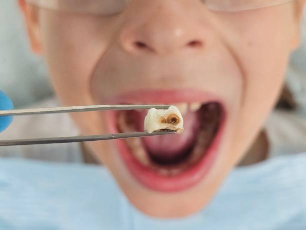 Best Emergency Dental Care for Broken or Chipped Teeth in Hardin, MT
